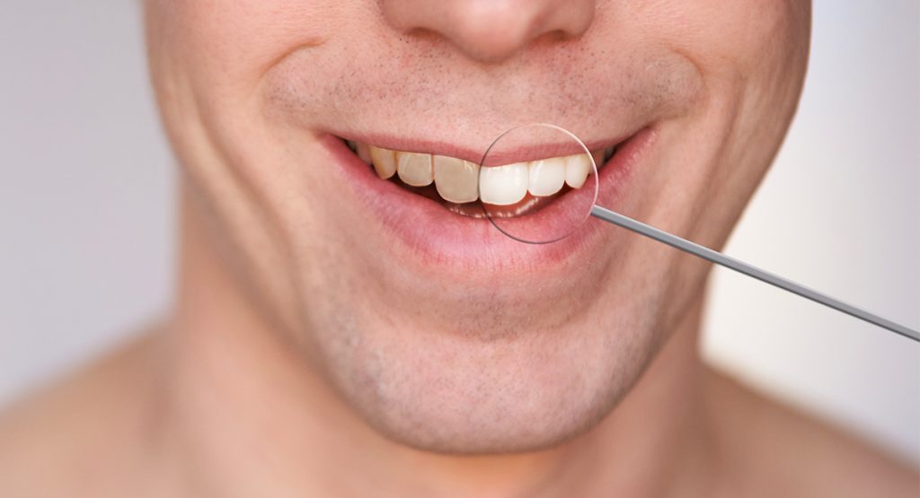 Sbiancamento-dentale